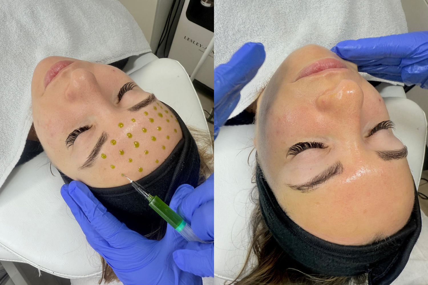 Formation - BioRePeel®